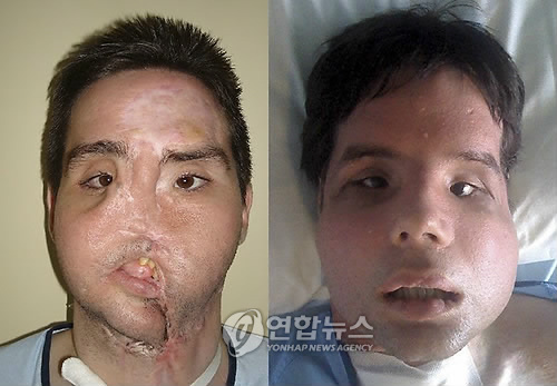 지난 4월 안면 전체이식 수술을 받은 오스카의 수술 받기 전후의 모습. 오스카는 스페인 바르셀로나의 발 데브론 병원에서 호안 바렛 의사가 이끄는 30명의 수술진에게 사고로 잃은 얼굴의 전면수술을 받았다. 사진은 발 데브론 병원이 제공.